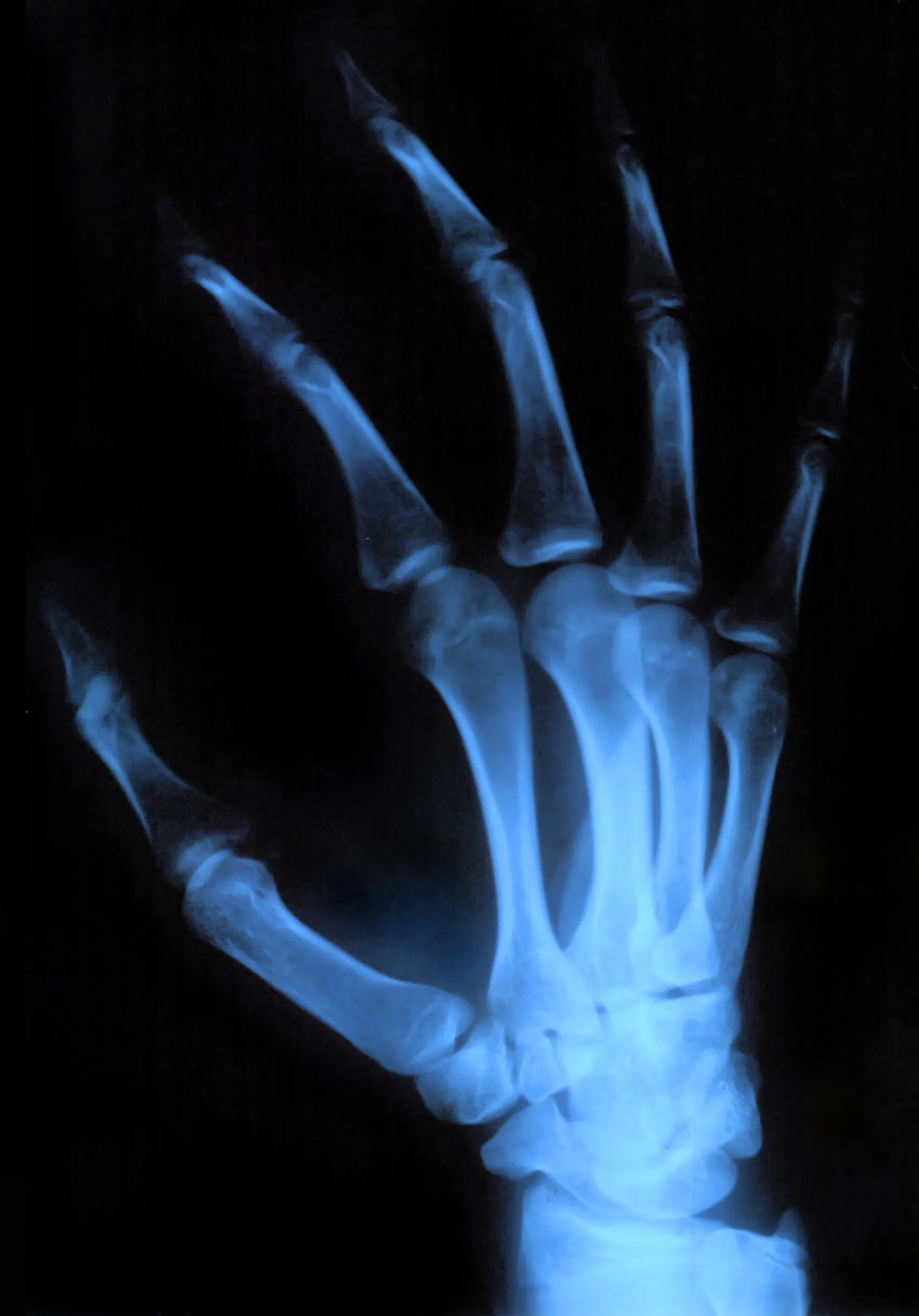 X-ray of a patient's hand who has wrist pain