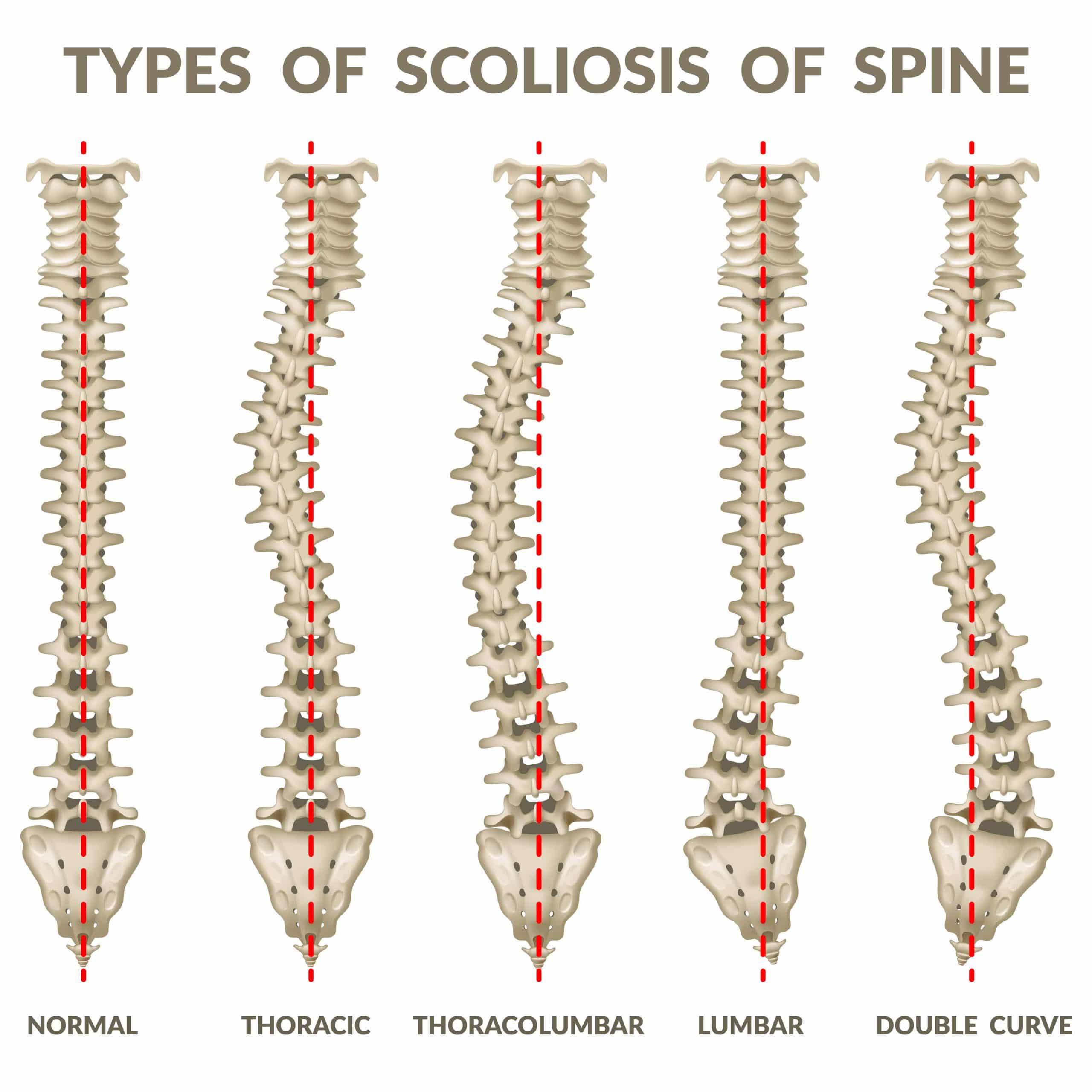 Scoliosis types chart showing 5 types of scoliosis that chiropractors can treat