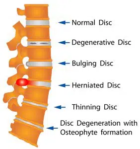 Disc Disorders and Their Treatment